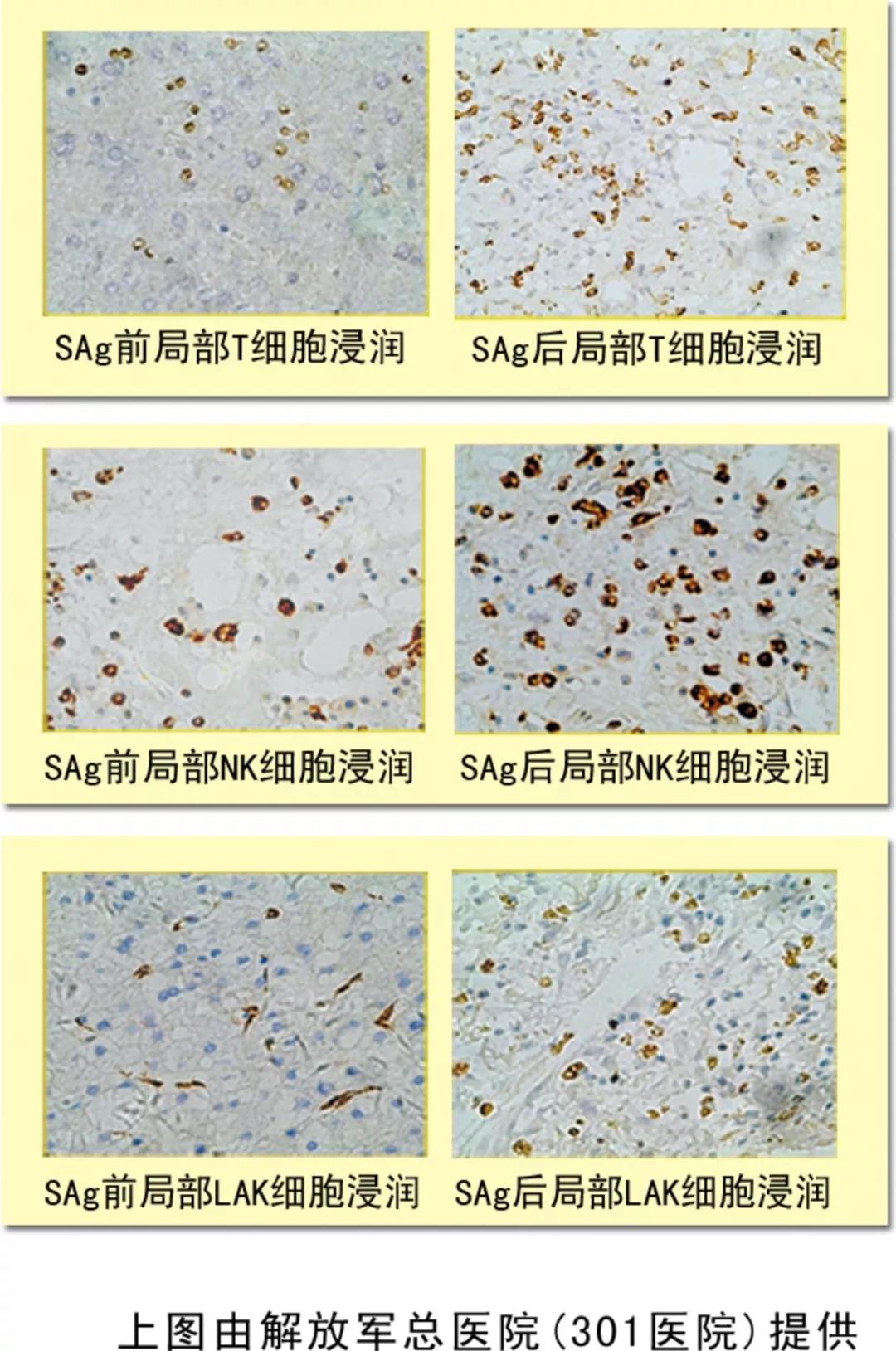 NK细胞，抗癌的第一道防线